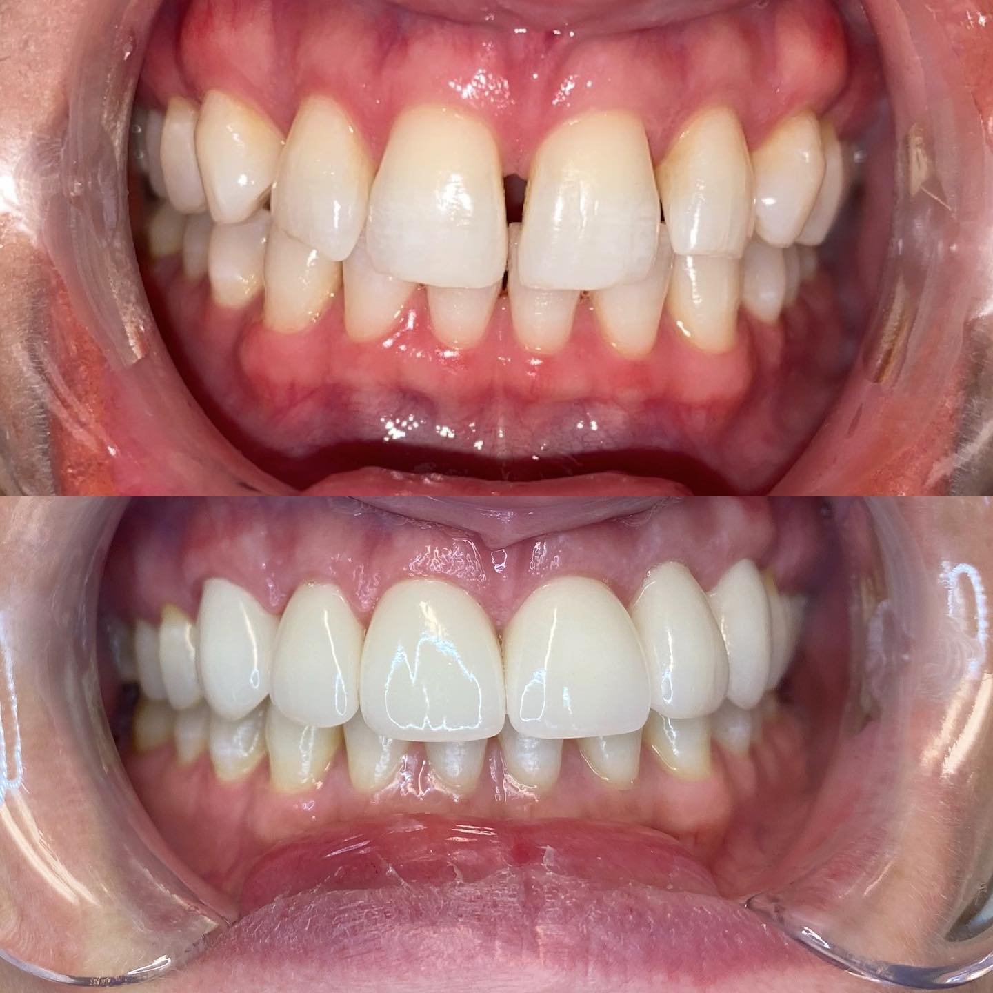 Happy Tuesday!! We love starting our week with beautiful transformations like this one! Call and schedule your consultation for your smile today! — at Auburn Dental Spa