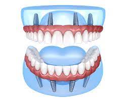 Affordable Dentures & Implants