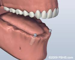 DDS Dentures + Implant Solutions of Jonesboro