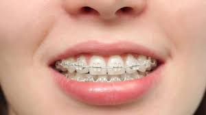 Pay Less 4 Braces - Connecticut