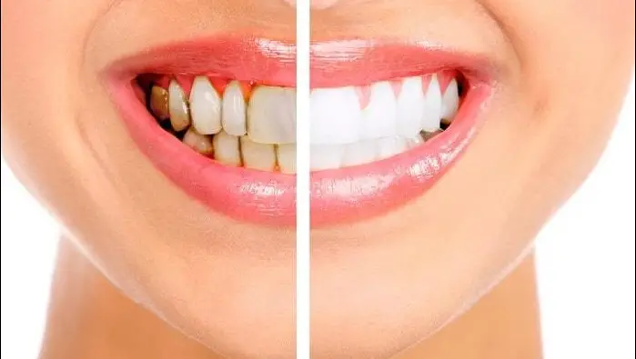 Dental Teeth Whitening..