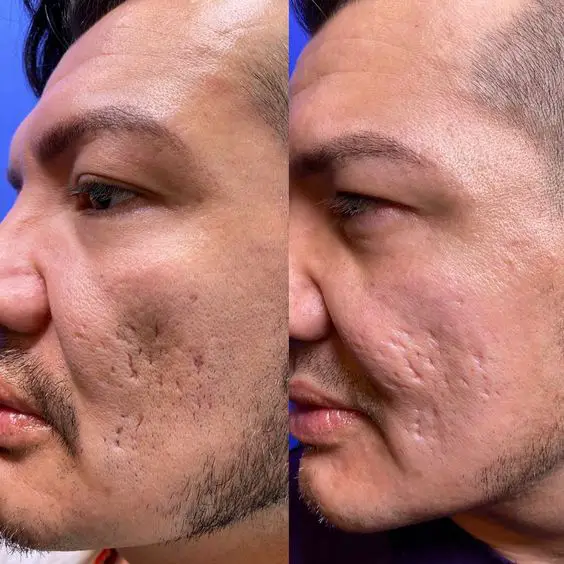 Acne scar removal