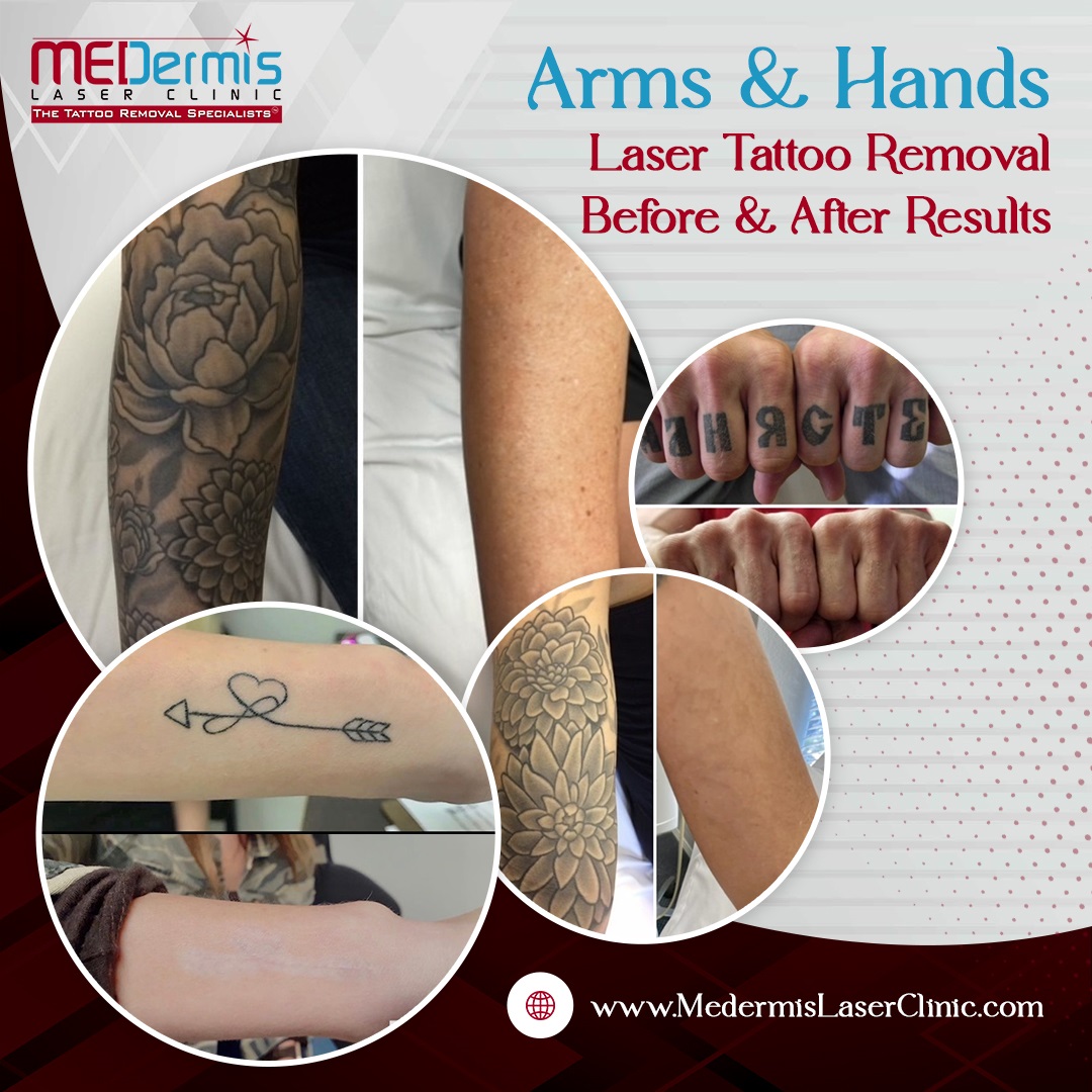 arms laser tattoo removal