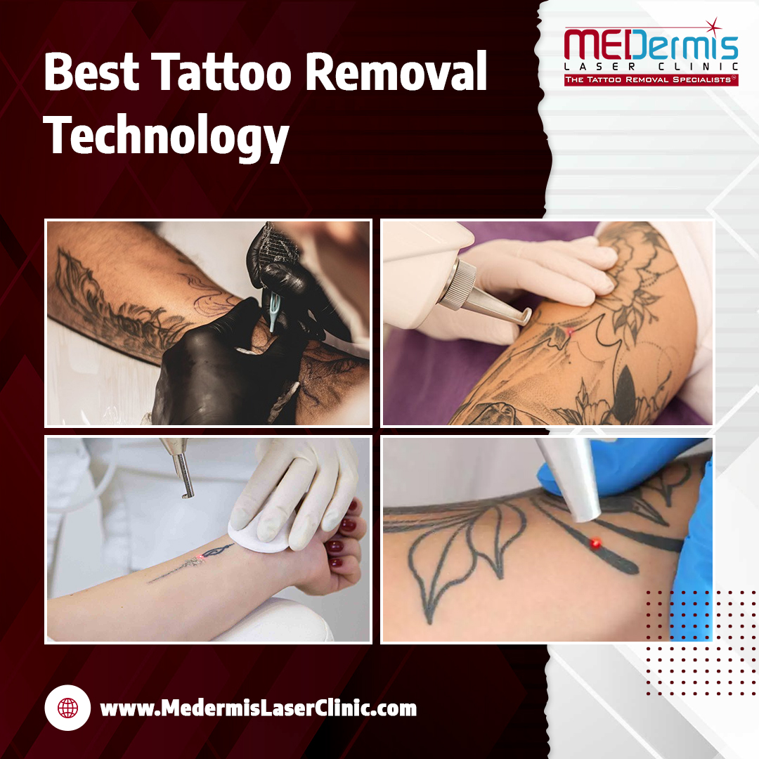 best tattoo removal technology