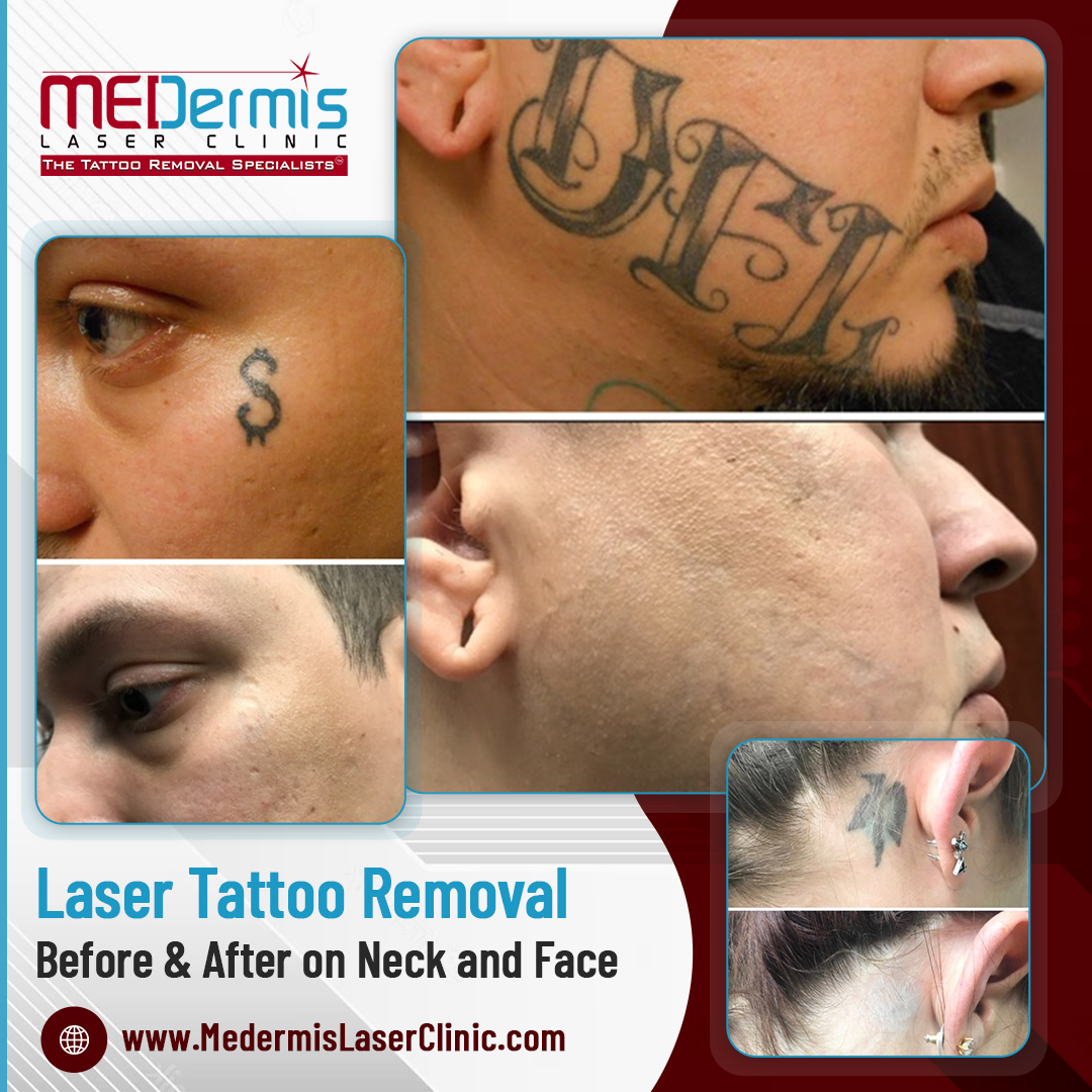 Neck & face tattoo removal before and after results