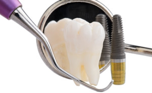 dental implants - dental implant professionals - melbourne