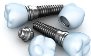 tooth implants - dental implant professionals - melbourne